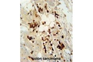 WDR21C antibody (N-term) immunohistochemistry analysis in formalin fixed and paraffin embedded human colon carcinoma followed by peroxidase conjugation of the secondary antibody and DAB staining. (DCAF4L2 抗体  (N-Term))