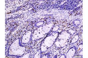 Formalin-fixed and paraffin embedded human colon cancer tissue labeled with Anti-Beta-Catenin (Ser33 + 37) Polyclonal Antibody, Unconjugated  at 1:200 followed by conjugation to the secondary antibody and DAB staining. (beta Catenin 抗体  (pSer33, pSer37))