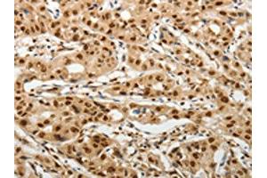 The image on the left is immunohistochemistry of paraffin-embedded Human lung cancer tissue using ABIN7192598(SOCS7 Antibody) at dilution 1/30, on the right is treated with synthetic peptide. (SOCS7 抗体)