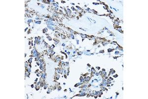 Immunohistochemistry of paraffin-embedded human thyroid cancer using O Rabbit pAb (ABIN6133230, ABIN6137338, ABIN6137339 and ABIN6224128) at dilution of 1:100 (40x lens). (ATP5O 抗体  (AA 24-213))