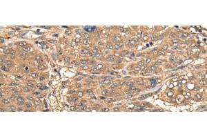 Immunohistochemistry of paraffin-embedded Human liver cancer tissue using CCL27 Polyclonal Antibody at dilution of 1:55(x200) (CCL27 抗体)