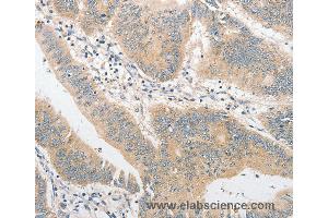 Immunohistochemistry of Human colon cancer using TLR4 Polyclonal Antibody at dilution of 1:40 (TLR4 抗体)