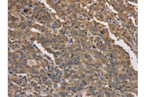 The image on the left is immunohistochemistry of paraffin-embedded Human liver cancer tissue using ABIN7191171(KCNG1 Antibody) at dilution 1/40, on the right is treated with synthetic peptide. (KCNG1 抗体)