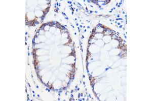 Immunohistochemistry of paraffin-embedded human colon carcinoma using TMED3 antibody (ABIN7270944) at dilution of 1:100 (40x lens). (TMED3 抗体  (AA 24-180))