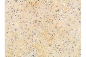 ABIN6265357 and ABIN6278222 at 1/100 staining human hepatocellular carcinoma by IHC-P. (STXBP1 抗体  (C-Term))