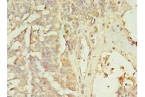Immunohistochemistry of paraffin-embedded human endometrial cancer using ABIN7176501 at dilution of 1:100 (ZNF699 抗体  (AA 19-195))
