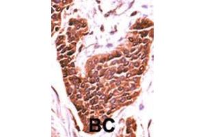 Formalin-fixed and paraffin-embedded human cancer tissue reacted with the primary antibody, which was peroxidase-conjugated to the secondary antibody, followed by DAB staining. (BRSK2 抗体  (C-Term))
