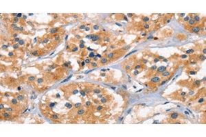 Immunohistochemistry of paraffin-embedded Human thyroid cancer tissue using AHR Polyclonal Antibody at dilution 1:50 (Aryl Hydrocarbon Receptor 抗体)