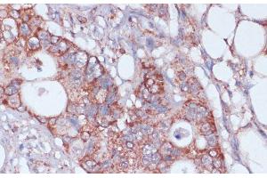 Immunohistochemistry of paraffin-embedded Human colon carcinoma using MRPL23 Polyclonal Antibody at dilution of 1:100 (40x lens). (MRPL23 抗体)