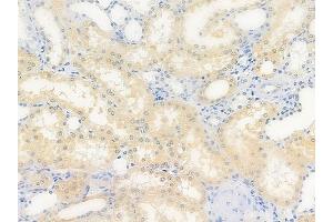 ABIN6264994 and ABIN6279792 at 1/100 staining human renal cell carcinoma by IHC-P.
