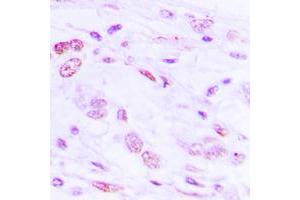 Immunohistochemical analysis of ATF2 (pS112) staining in human lung cancer formalin fixed paraffin embedded tissue section. (ATF2 抗体  (pSer112))