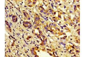 Immunohistochemistry of paraffin-embedded human liver cancer using ABIN7148357 at dilution of 1:100 (C1S 抗体  (AA 519-688))