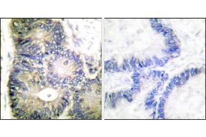 Immunohistochemical analysis of paraffin-embedded human colon carcinoma tissue using Cytochrome c antibody. (Cytochrome C 抗体)