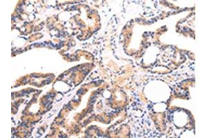 The image on the left is immunohistochemistry of paraffin-embedded Human thyroid cancer tissue using ABIN7191260(Lambda Light chain Antibody) at dilution 1/20, on the right is treated with synthetic peptide. (IGLV1-51 抗体)