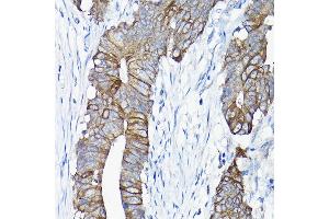 Immunohistochemistry of paraffin-embedded human colon carcinoma using  antibody (ABIN6127437, ABIN6136922, ABIN6136923 and ABIN6217829) at dilution of 1:50 (40x lens). (Annexin A13 抗体  (AA 1-316))