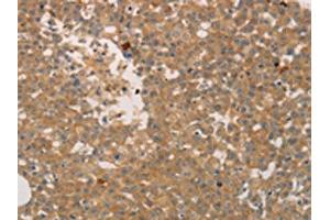 The image on the left is immunohistochemistry of paraffin-embedded Human breast cancer tissue using ABIN7189672(ADCYAP1R1 Antibody) at dilution 1/70, on the right is treated with synthetic peptide.