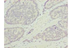 Immunohistochemistry of paraffin-embedded human gastric cancer using ABIN7162346 at dilution of 1:100 (ODF3L1 抗体  (AA 1-274))