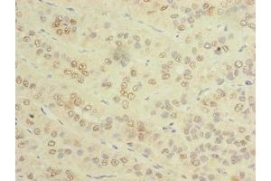Immunohistochemistry of paraffin-embedded human liver cancer using ABIN7173459 at dilution of 1:100 (TRIM51 抗体  (AA 160-452))