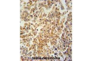 TEX9 antibody (N-term) immunohistochemistry analysis in formalin fixed and paraffin embedded human testis carcinoma followed by peroxidase conjugation of the secondary antibody and DAB staining. (TEX9 抗体  (N-Term))