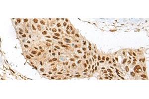 Immunohistochemistry of paraffin-embedded Human esophagus cancer tissue using ATE1 Polyclonal Antibody at dilution of 1:60(x200) (ATE1 抗体)