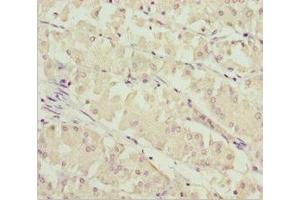 Immunohistochemistry of paraffin-embedded human gastric cancer using ABIN7171004 at dilution of 1:100 (SOCS4 抗体  (AA 1-270))