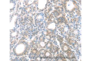 Immunohistochemistry of Human thyroid cancer using MAGED1 Polyclonal Antibody at dilution of 1:30