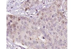 ABIN6266557 at 1/100 staining human liver carcinoma tissue sections by IHC-P. (HCG beta 抗体)