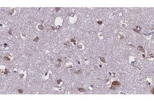 ABIN6276107 at 1/100 staining Human brain cancer tissue by IHC-P. (Mu Opioid Receptor 1 抗体  (C-Term))