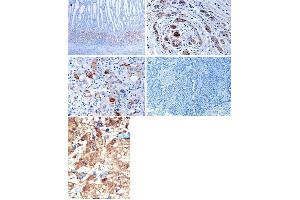 (TOP)Immunohistochemical analysis of EphB1 in gastric cancer tissues. (EPH Receptor B1 抗体  (C-Term))