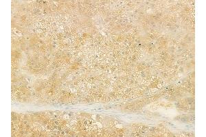 ABIN6259709 and ABIN6273189 at 1/100 staining human hepatocellular carcinoma by IHC-P. (ACAA1 抗体  (N-Term))