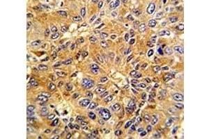 IHC analysis of FFPE human hepatocarcinoma with Cyclin A2 antibody (Cyclin A 抗体  (AA 51-84))