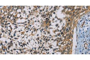 Immunohistochemistry of paraffin-embedded Human cervical cancer using CSNK1E Polyclonal Antibody at dilution of 1:60 (CK1 epsilon 抗体)