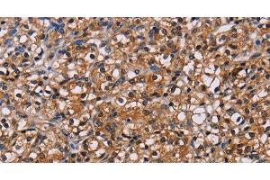 Immunohistochemistry of paraffin-embedded Human prostate cancer using NPM3 Polyclonal Antibody at dilution of 1:60 (NPM3 抗体)