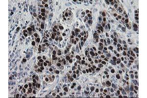 Immunohistochemical staining of paraffin-embedded Carcinoma of Human lung tissue using anti-HSPBP1 mouse monoclonal antibody. (HSPBP1 抗体)