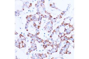 Immunohistochemistry of paraffin-embedded human thyroid cancer using SIRT3 antibody  at dilution of 1:100 (40x lens). (SIRT3 抗体  (C-Term))