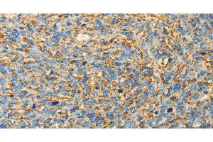 Immunohistochemistry of paraffin-embedded Human ovarian cancer tissue using APOA4 Polyclonal Antibody at dilution 1:30