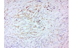 Formalin-fixed and paraffin embedded human laryngeal carcinoma labeled with Anti-MMP-2 Polyclonal Antibody, Unconjugated  at 1:200 followed by conjugation to the secondary antibody and DAB staining. (MMP2 抗体  (AA 401-500))