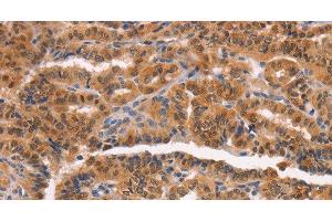 Immunohistochemistry of paraffin-embedded Human thyroid cancer tissue using NCAPG2 Polyclonal Antibody at dilution 1:50 (NCAPG2 抗体)