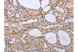 The image on the left is immunohistochemistry of paraffin-embedded Human thyroid cancer tissue using ABIN7192969(TYROBP Antibody) at dilution 1/30, on the right is treated with synthetic peptide. (TYROBP 抗体)