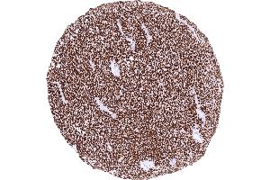 Synovial sarcoma with strong TLE1 positivity of all tumor cells