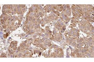 ABIN6268902 at 1/100 staining Human Melanoma tissue by IHC-P. (MMP13 抗体  (N-Term))