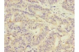 Immunohistochemistry of paraffin-embedded human colon cancer using ABIN7154098 at dilution of 1:100 (GSTK1 抗体  (AA 1-226))