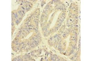 Immunohistochemistry of paraffin-embedded human colon cancer using ABIN7145012 at dilution of 1:100 (YME1L1 抗体  (AA 1-240))