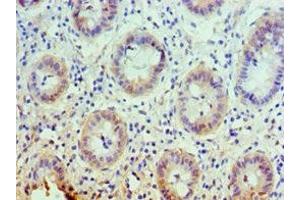 Immunohistochemistry of paraffin-embedded human colon cancer using ABIN7146355 at dilution of 1:100 (slc25a13 抗体  (AA 1-300))