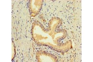 Immunohistochemistry of paraffin-embedded human prostate cancer using ABIN7145692 at dilution of 1:100 (BMP4 抗体  (AA 303-408))