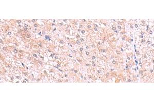 Immunohistochemistry of paraffin-embedded Human liver cancer tissue using PISD Polyclonal Antibody at dilution of 1:80(x200) (PISD 抗体)