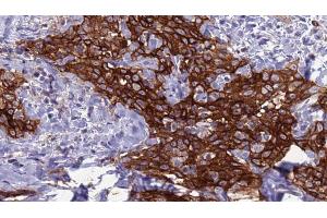 ABIN6272285 at 1/100 staining Human Head and neck cancer tissue by IHC-P. (DCL1 抗体  (Internal Region))