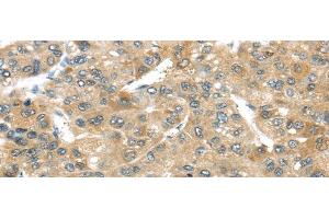 Immunohistochemistry of paraffin-embedded Human liver cancer tissue using TMPRSS4 Polyclonal Antibody at dilution 1:50 (TMPRSS4 抗体)