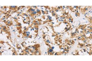 Immunohistochemistry of paraffin-embedded Human thyroid cancer using COX6B1 Polyclonal Antibody at dilution of 1:50 (COX6B1 抗体)