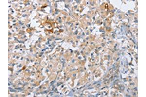 The image on the left is immunohistochemistry of paraffin-embedded Human thyroid cancer tissue using ABIN7190211(CENPE Antibody) at dilution 1/50, on the right is treated with synthetic peptide. (CENPE 抗体)